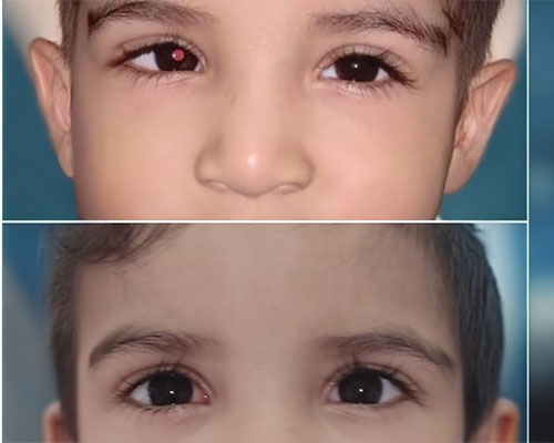 paediatric-eye-care